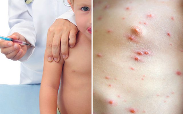 Caution causes school to close due to chickenpox.